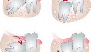 Nhổ răng khôn bằng máy phẫu thuật siêu âm Piezotome