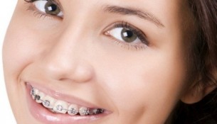 Thời gian chỉnh nha niềng răng là trong bao lâu?