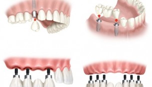 Cấy ghép implant - phương pháp trồng răng hoàn hảo