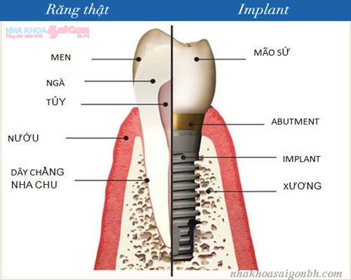 Chi phí trồng răng implant giá bao nhiêu tiền?