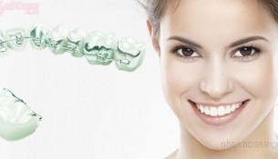 Tự tin hơn với phương pháp chỉnh nha niềng răng mặt trong