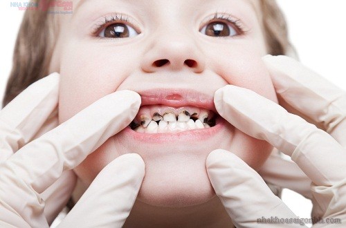 Sâu răng sữa ở trẻ em