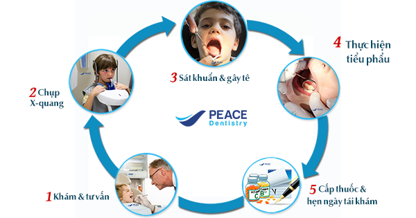 Quy trình dịch vụ nhổ răng sữa tại Peace Dentistry