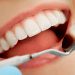Làm thế nào để duy trì độ bền của bọc răng sứ