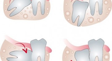 Nhổ răng khôn bằng máy phẫu thuật siêu âm Piezotome