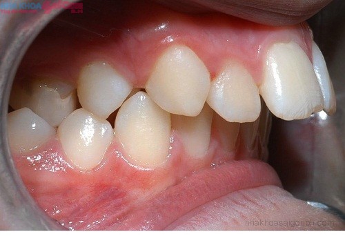 Niềng răng có điều trị hô do xương hàm được không?