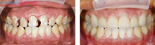 Trước và sau khi bọc răng sứ thẩm mỹ